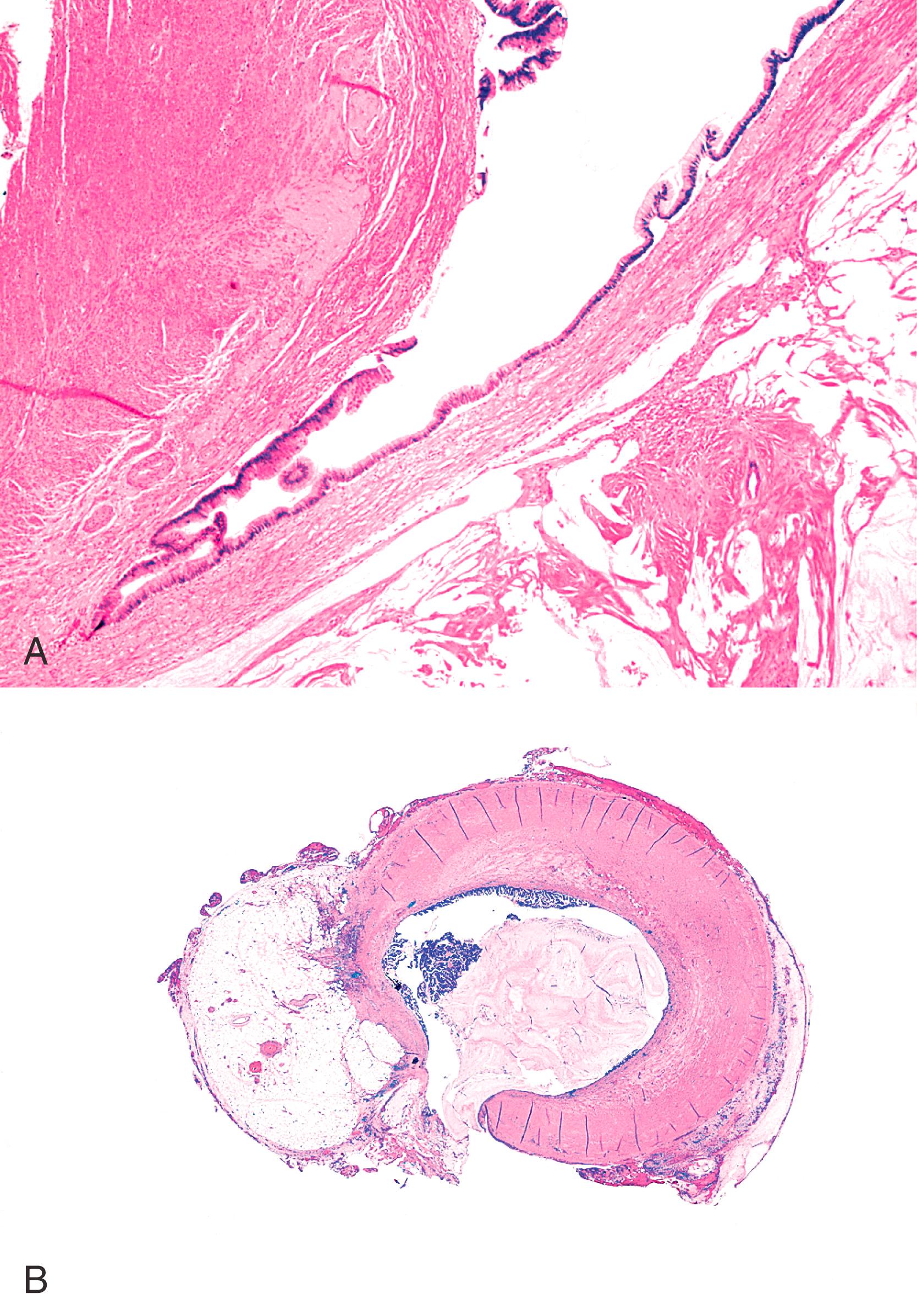 FIGURE 28.6, Examples of pushing invasion in low-grade appendiceal mucinous neoplasm.