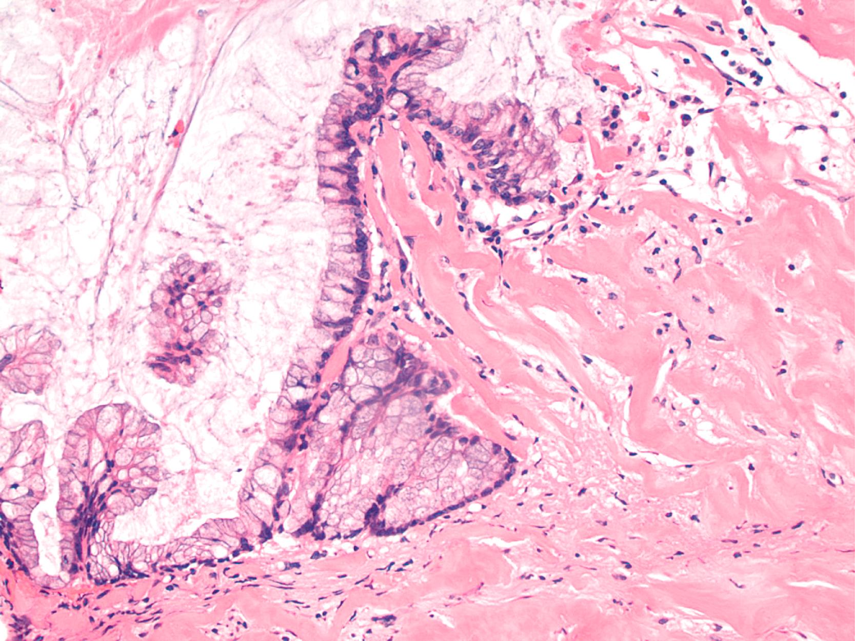 FIGURE 28.7, Low-grade appendiceal mucinous neoplasm with pushing invasion. The mucinous neoplasm is growing atop hyalinized tissue, without lamina propria or muscularis mucosae.
