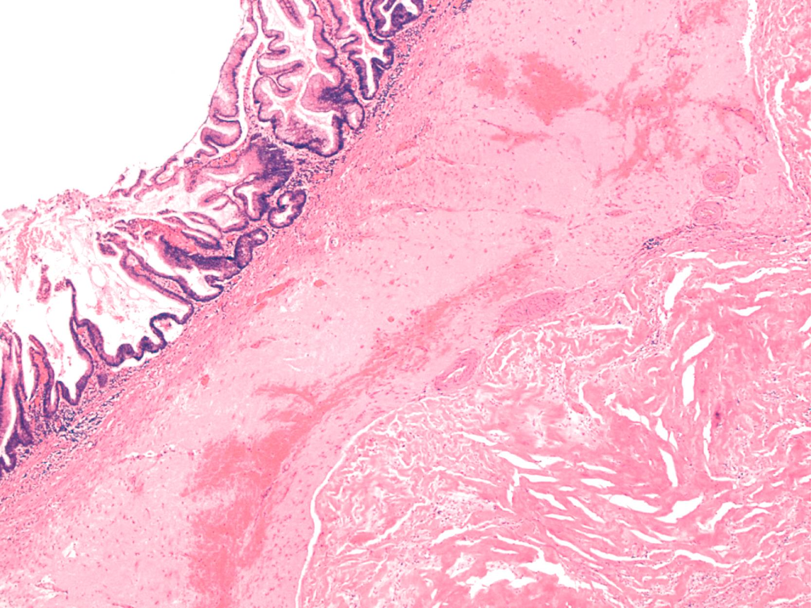 FIGURE 28.8, Low-grade appendiceal mucinous neoplasm demonstrating submucosal fibrosis and marked mural hyalinization with a nodular hyalinized scar (lower right).