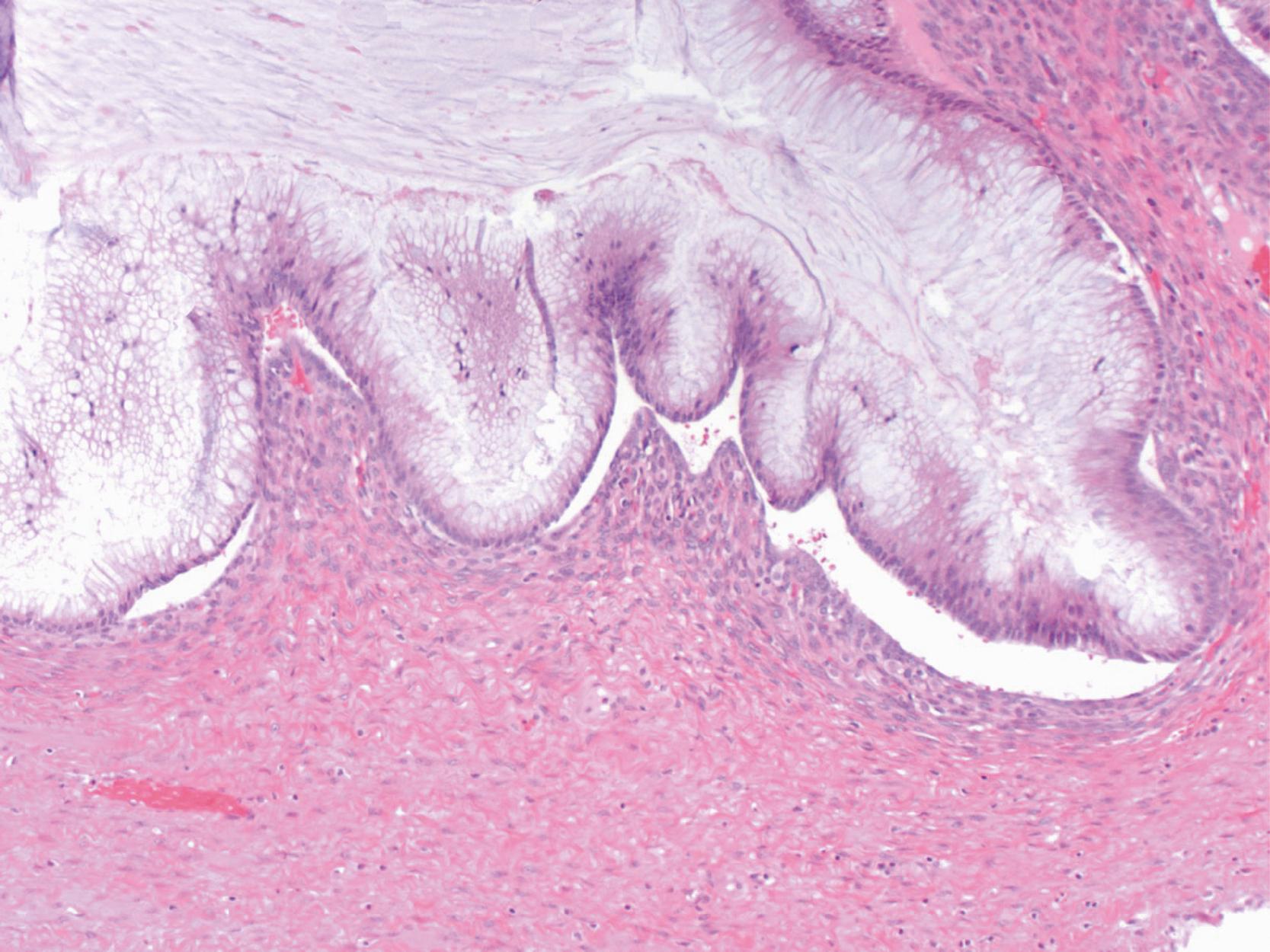 FIGURE 28.9, Ovarian involvement by a low-grade appendiceal mucinous neoplasm.