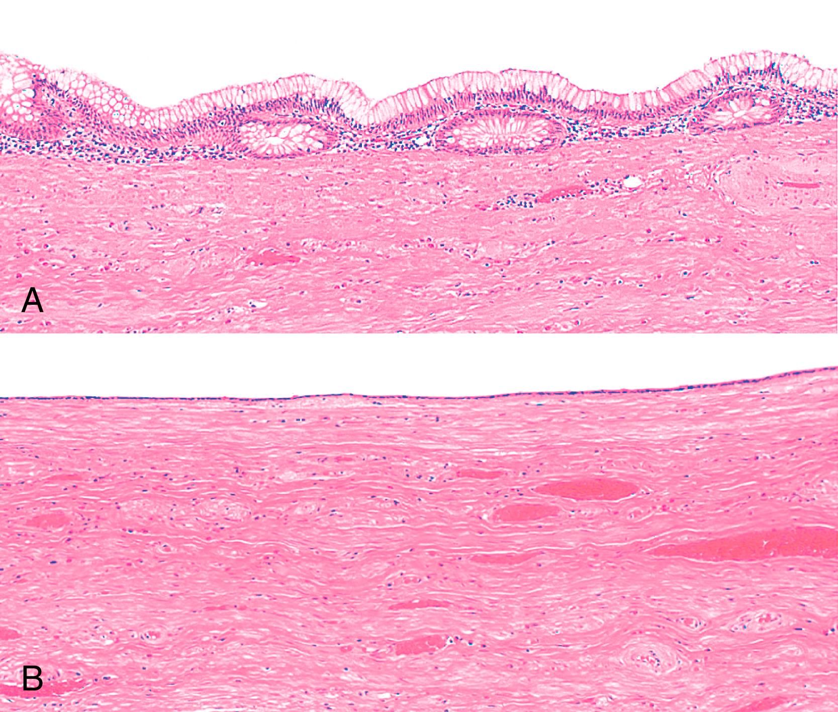 FIGURE 28.10, Retention cyst of the appendix with dilatation of the appendiceal lumen.