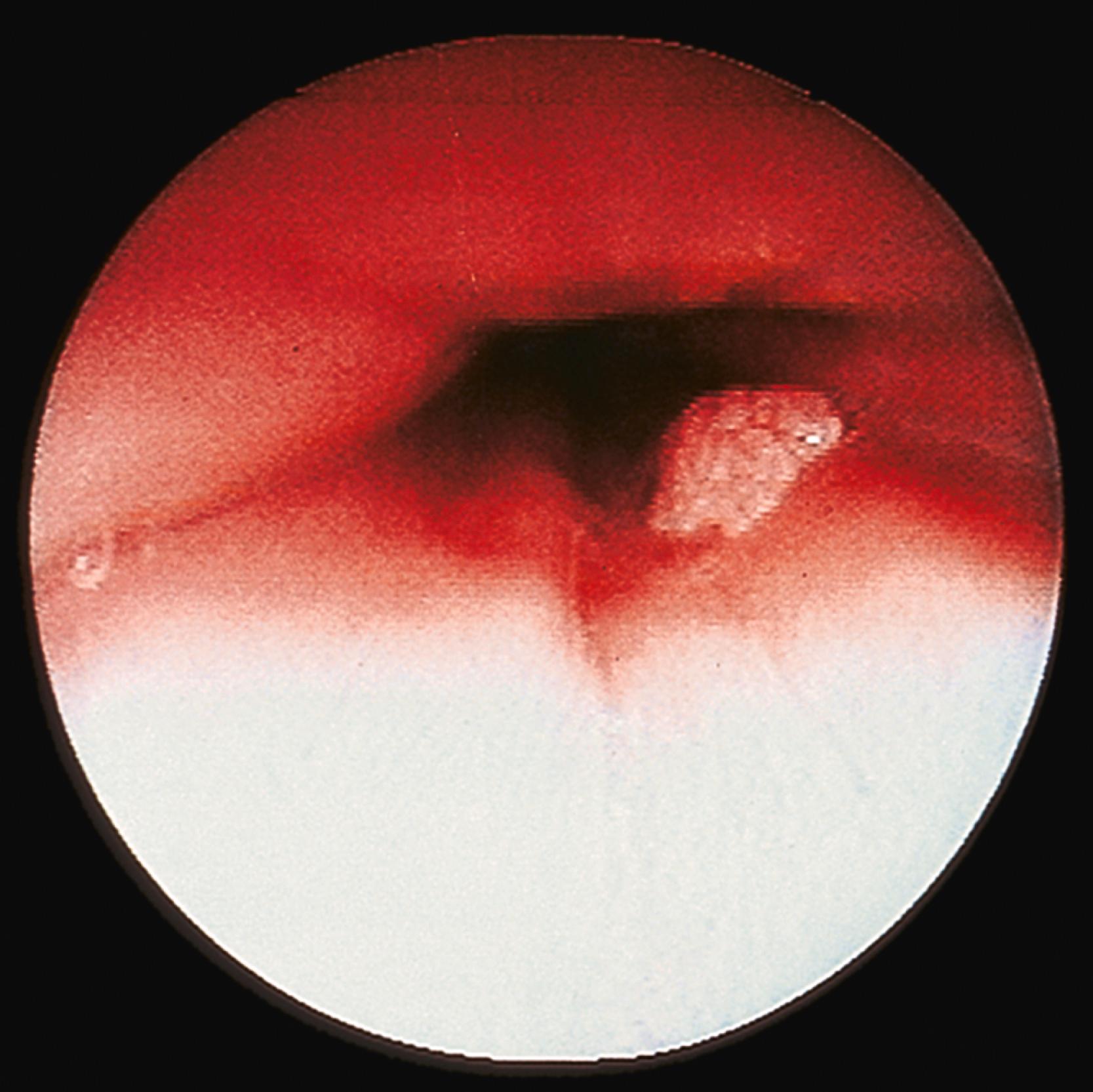 FIGURE 24.1, Endoscopic photograph of an exophytic squamous papilloma of the esophagus showing a well-circumscribed, broad-based nodule with a verrucoid irregular surface.