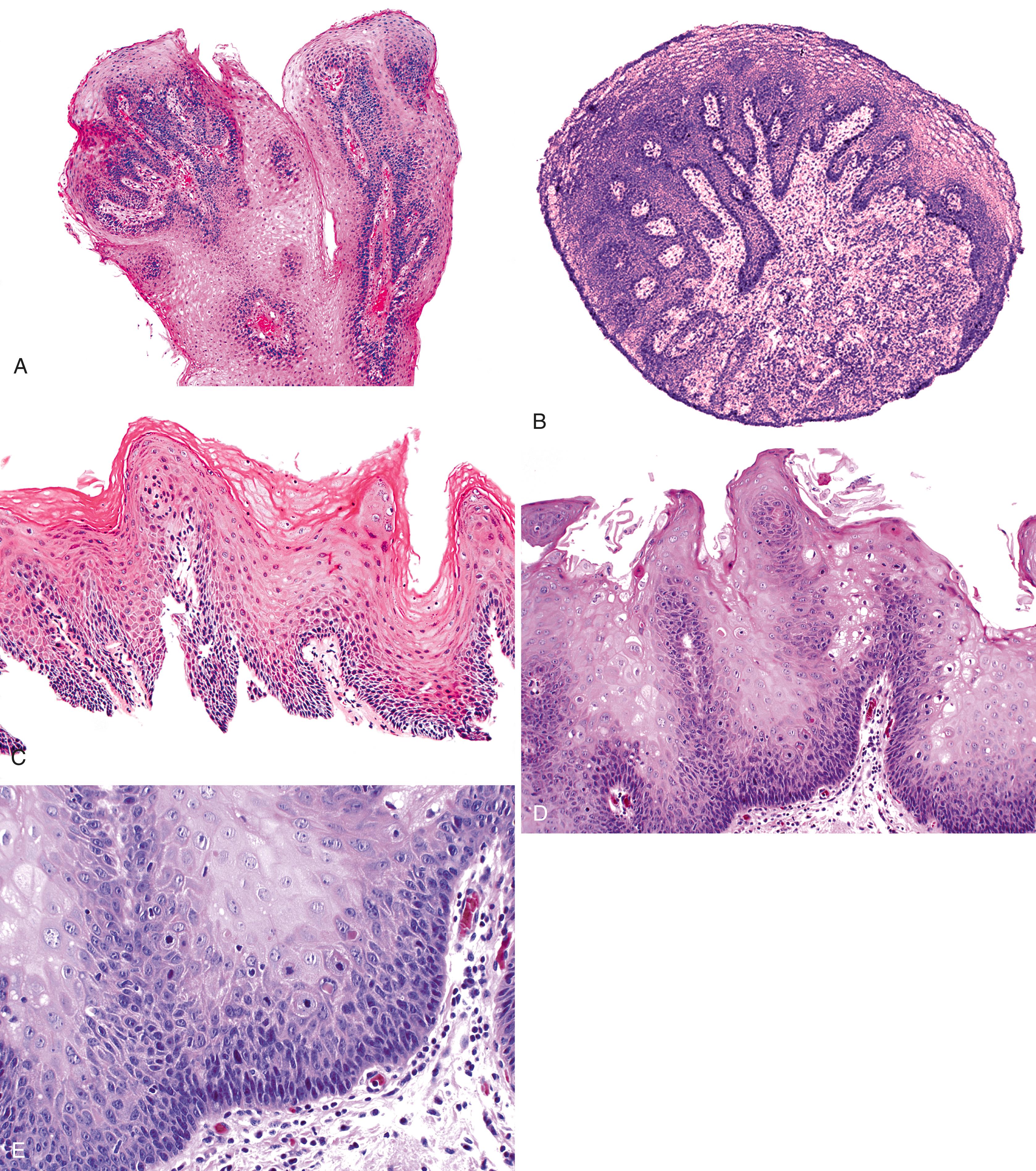 FIGURE 24.2, A, Exophytic squamous papilloma of the esophagus. This lesion shows finger-like projections of acanthotic squamous epithelium covering fibrovascular lamina propria pegs. B, Endophytic-type squamous papilloma showing an inverted papillomatous surface contour. C, Spiked-type squamous papilloma showing prominent spikes of acanthotic epithelium with marked hyperkeratosis and hypergranulosis. D, Medium-power photomicrograph of a case of diffuse papillomatosis. Notice the superficial keratinocytes with koilocytosis. E, The deep portion of the same papilloma as in D shows basal zone hyperplasia.