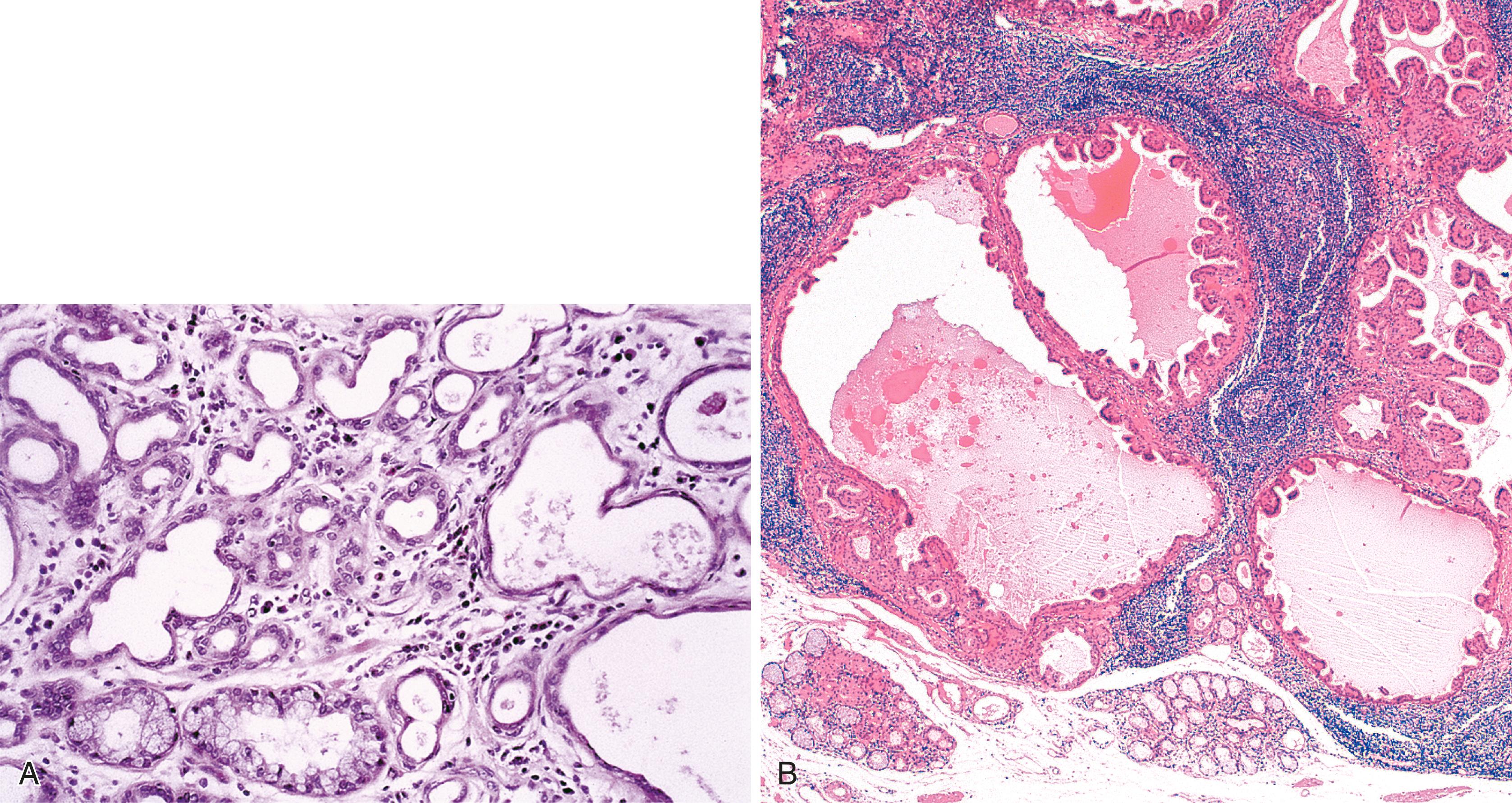 FIGURE 24.3, Benign gland/duct adenoma of the esophagus.