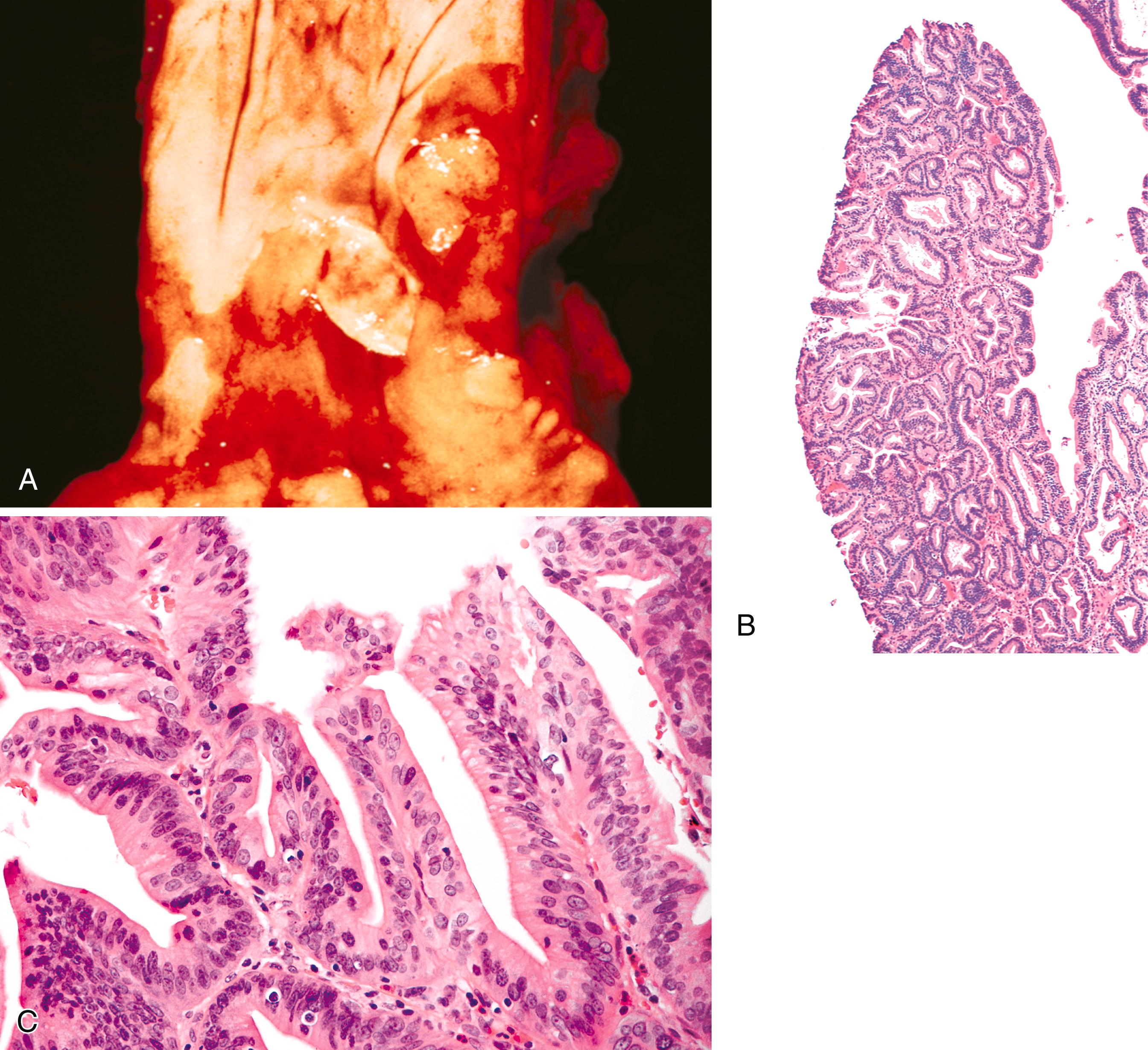 FIGURE 24.4, Polypoid dysplasia in Barrett’s esophagus.