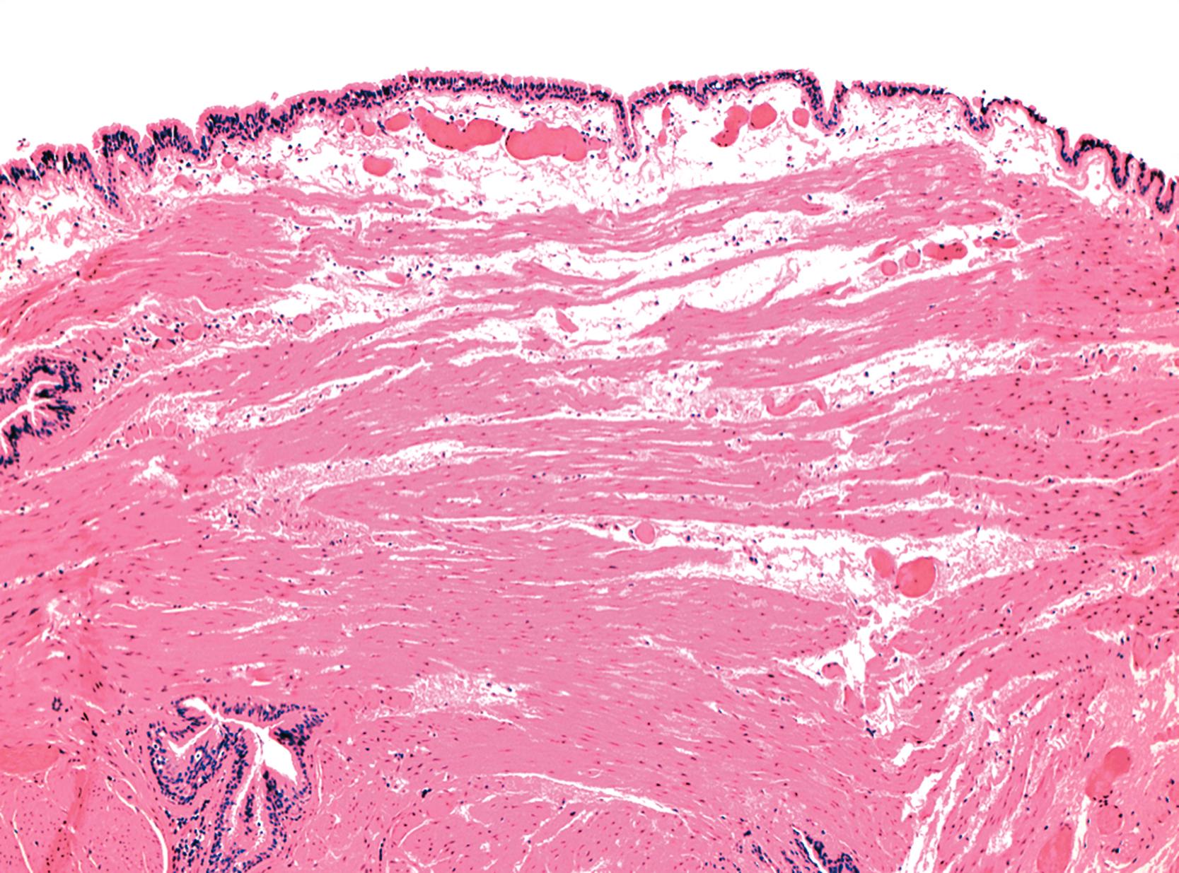 FIGURE 24.5, Bronchogenic cyst.