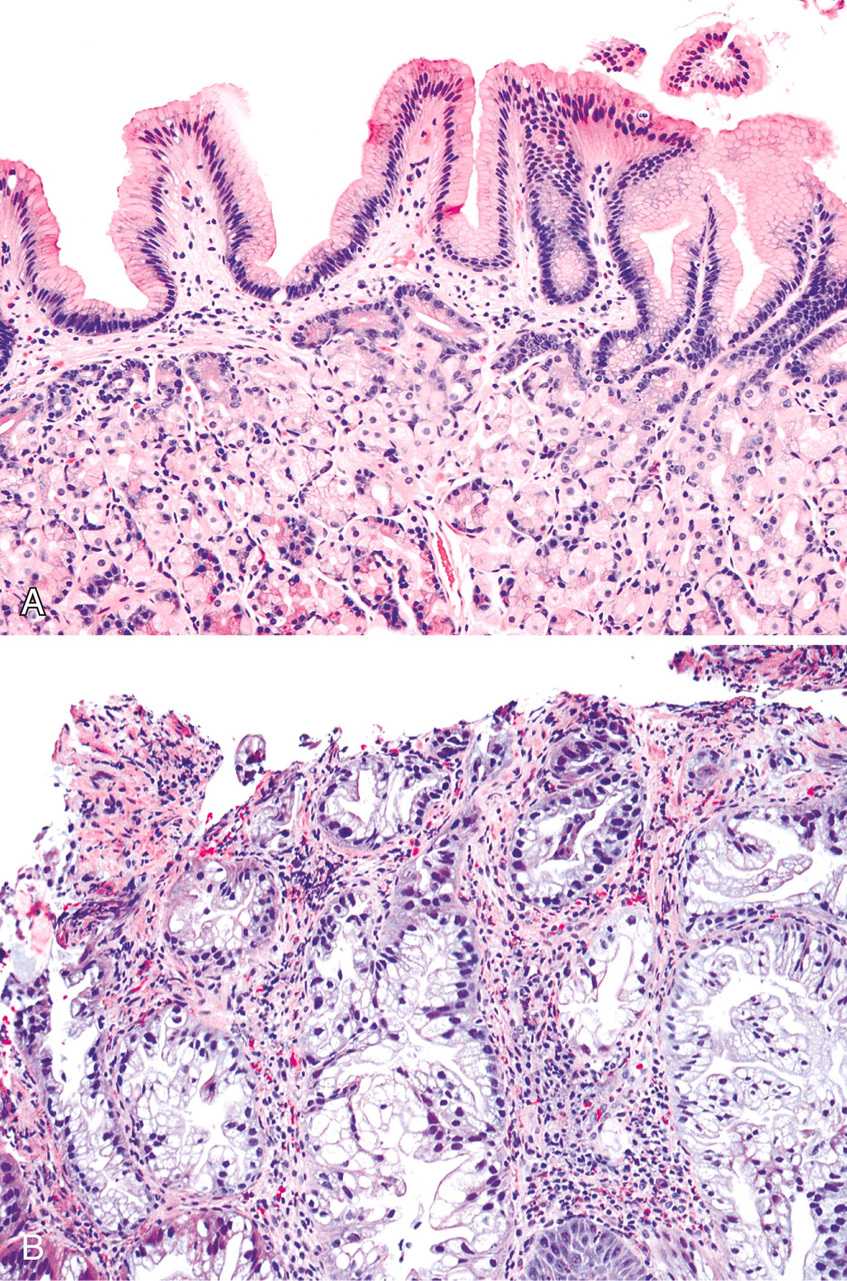 FIGURE 24.6, Gastric heterotopia. A, Gastric surface epithelium and oxyntic glands from a heterotopia in the upper esophagus. B, Poorly differentiated adenocarcinoma (bottom) is arising in a focus of gastric heterotopia.