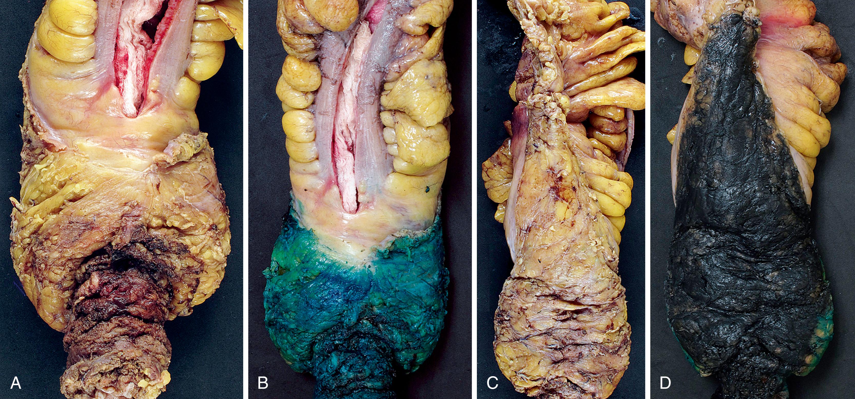 FIGURE 27.8, Example of a total mesorectal excision specimen.