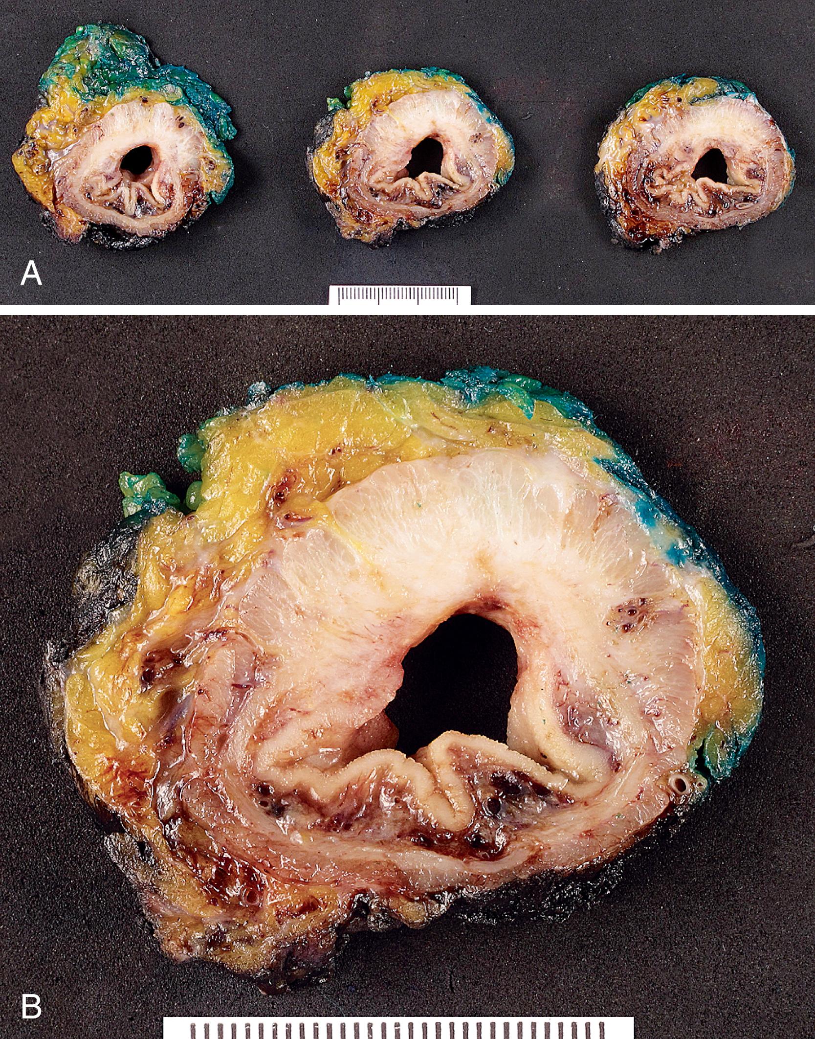 FIGURE 27.9, A, Cross sections of total mesorectal excision specimen. Tumor is visible extending through the muscularis propria and abutting the inked radial margin. B, Closer view of one cross-section.