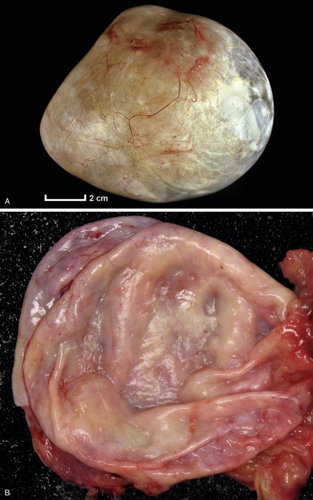 FIG. 14.1, Benign serous tumors. Serous cystadenoma appears grossly as a thin-walled cyst with smooth and glistening external surface (A). Upon opening, the inner surface is smooth and devoid of excrescences (B). Serous cystadenofibroma has various amounts of fibrous stroma, seen grossly as solid nodular or thickened areas within the cyst (C). The fibromatous component sometimes forms excrescences within the wall (D).