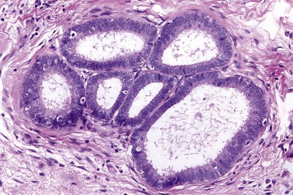 FIG. 14.11, Endosalpingiosis. Simple glands are lined by ciliated cuboidal to columnar epithelium with minimal cytologic atypia. Note the absence of papillary infolding.