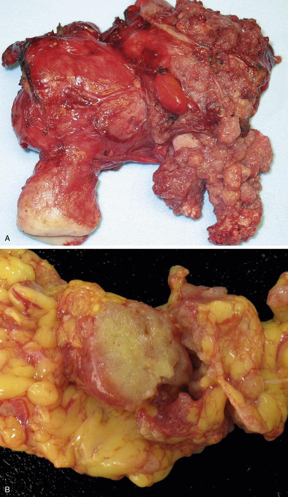 FIG. 14.13, Low-grade serous carcinoma. Large, bulky tumor replacing the ovary with prominent excrescences on the external surface (A). Omental involvement by low-grade serous carcinoma is seen as a firm, tan to yellow solid mass (B).