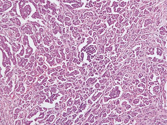 FIG. 14.14, Low-grade serous carcinoma. Closely packed papillae and small nests of cells replace stroma and are surrounded by clefts.