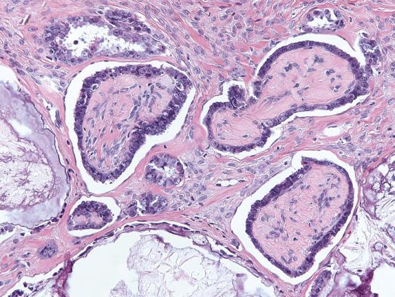 FIG. 14.15, Low-grade serous carcinoma. Inverted macropapillae are surrounded by stromal clefts.