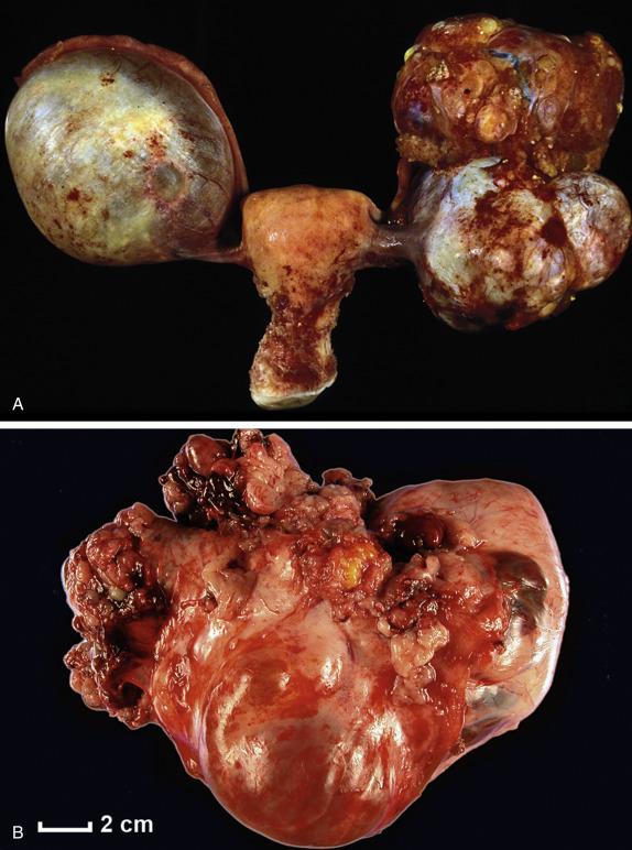 FIG. 14.17, High-grade serous carcinoma. Predominantly solid and focally necrotic tumors replace both ovaries (A). Surface excrescences are present (B).