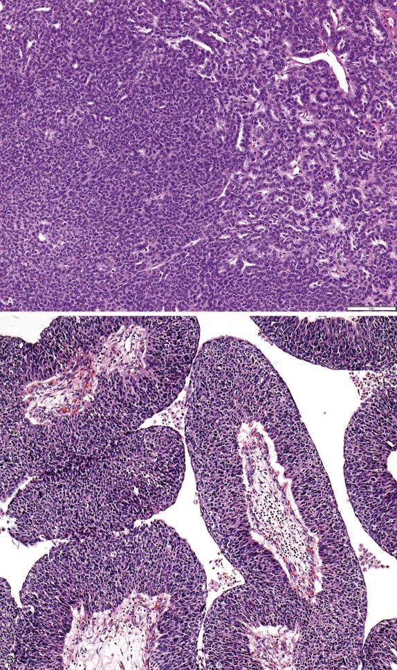 FIG. 14.19, High-grade serous carcinoma. Variant morphology, which can be misinterpreted as other ovarian tumor types, includes S olid (A, left), En dometrioid (A, right) and T ransitional growth (B). These are commonly known as SET patterns.