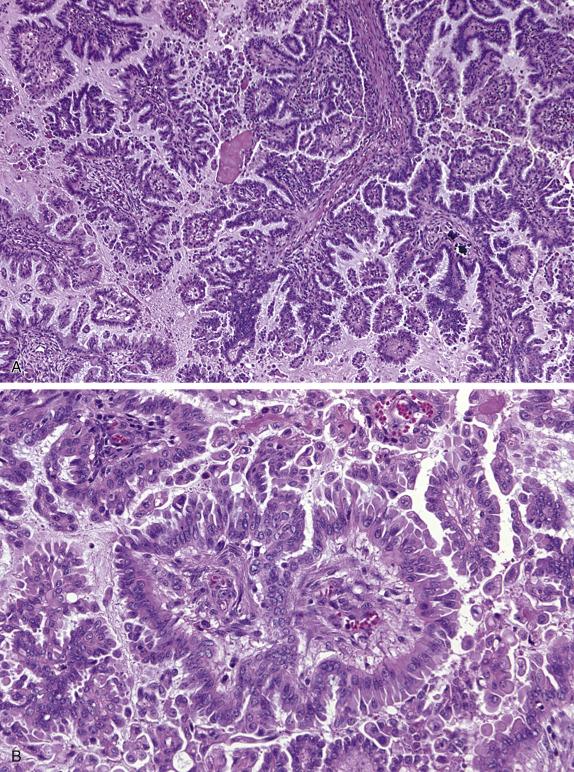 FIG. 14.4, Serous borderline tumor. Thick papillae with hierarchical branching are lined by stratified cuboidal to columnar cells and interspersed eosinophilic (pink) cells with tufting (A). Nuclear atypia is minimal and mitoses are not prominent (B).