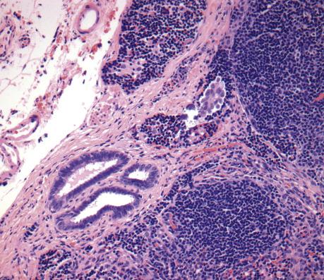 FIG. 14.7, Serous borderline tumor involving a lymph node. A single small papillary cluster of tumor cells is present in a subcapsular sinus. Also notice the presence of endosalpingiosis.