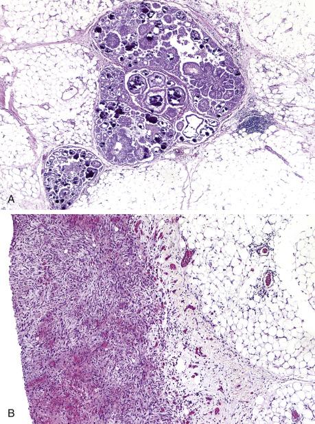 FIG. 14.8, Noninvasive implants. Cysts containing multiple papillae are present in omental septa. The interface between the implant and adjacent fat is smooth and no desmoplastic reaction is seen in this epithelial, noninvasive implant (A). Small papillae and single cells are embedded in abundant edematous, inflamed, and/or desmoplastic tissue. Note the well-demarcated interface between the implant and adjacent fat in this desmoplastic, noninvasive implant (B).