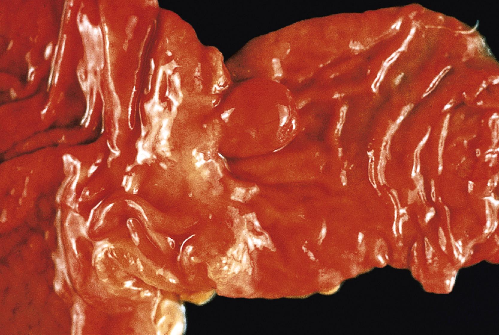 FIGURE 26.1, Duodenal adenoma.