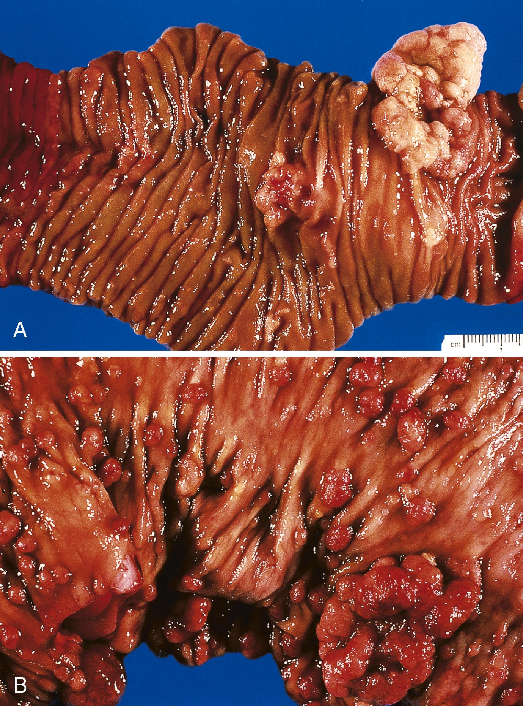 FIGURE 26.2, A, Duodenal resection specimen from a patient with familial adenomatous polyposis. Multiple pedunculated and sessile polyps (adenomas) are present. The largest polypoid lesion represents an adenoma with invasive adenocarcinoma. B, The colon from the same patient shows multiple adenomatous polyps as well as an invasive adenocarcinoma (bottom right).