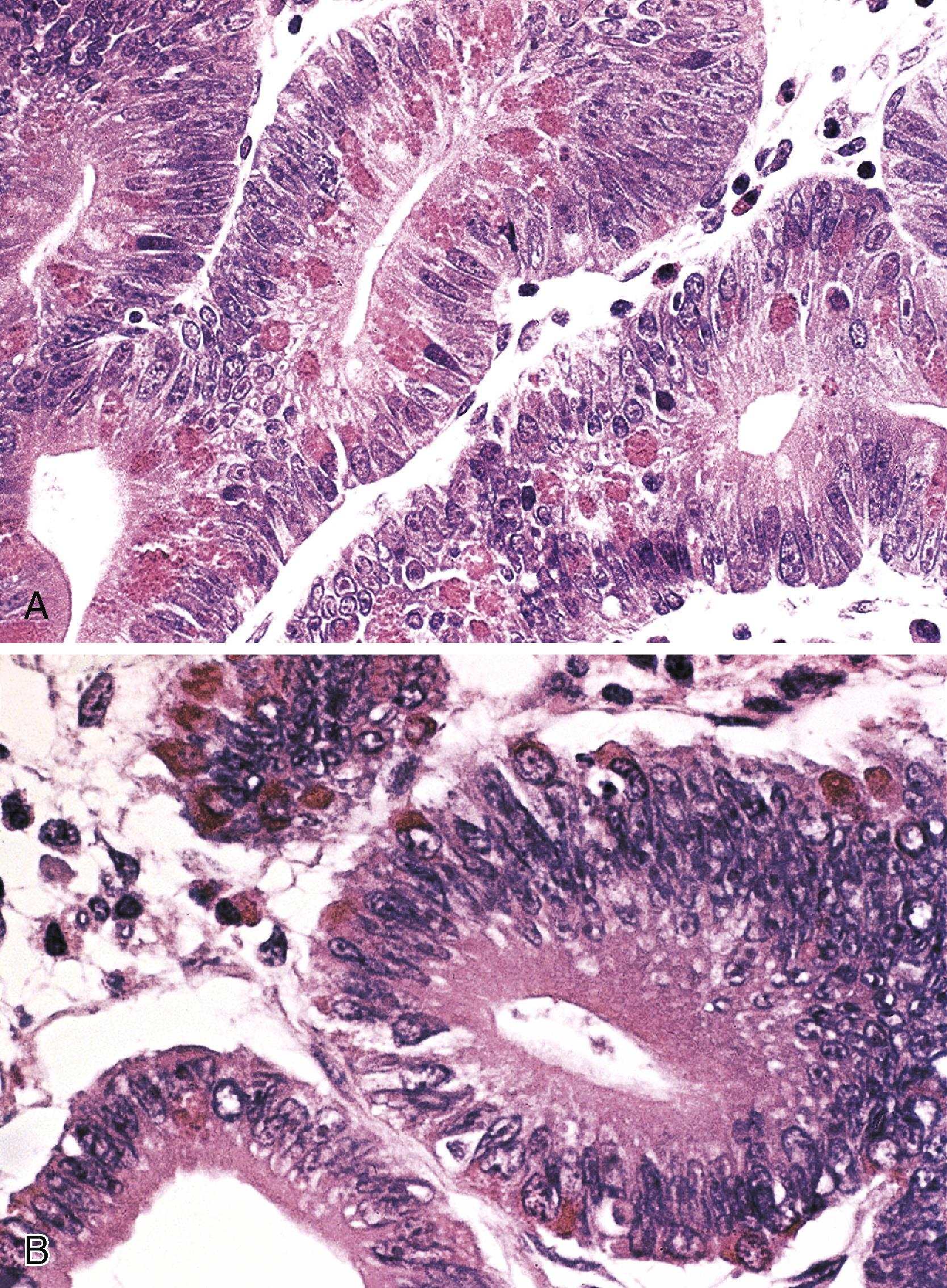 FIGURE 26.3, A, Paneth cells in a duodenal adenoma. Adenomatous crypts contain cells with coarse, eosinophilic, apical vacuoles characteristic of Paneth cells. B, This adenoma demonstrates the presence of large numbers of endocrine cells in the glands. These cells have finely granular, eosinophilic cytoplasm. In contrast to Paneth cells, the cytoplasmic granules of endocrine cells are less coarse and are present in a basal location.