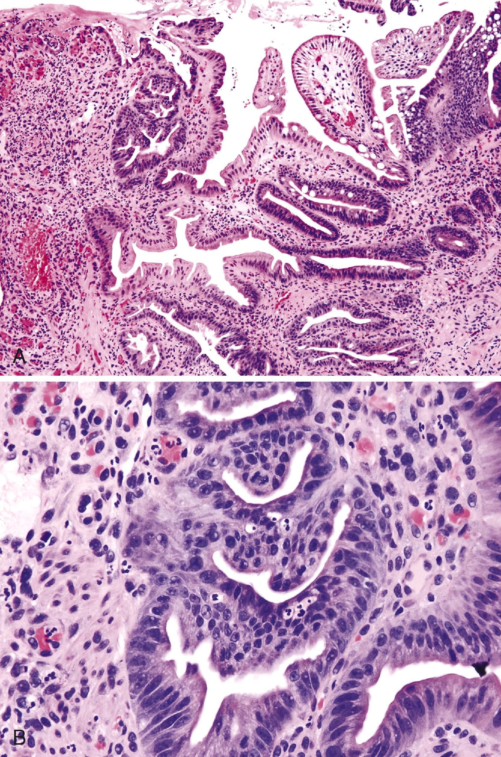 FIGURE 26.4, Regenerative atypia in an ampullary biopsy.