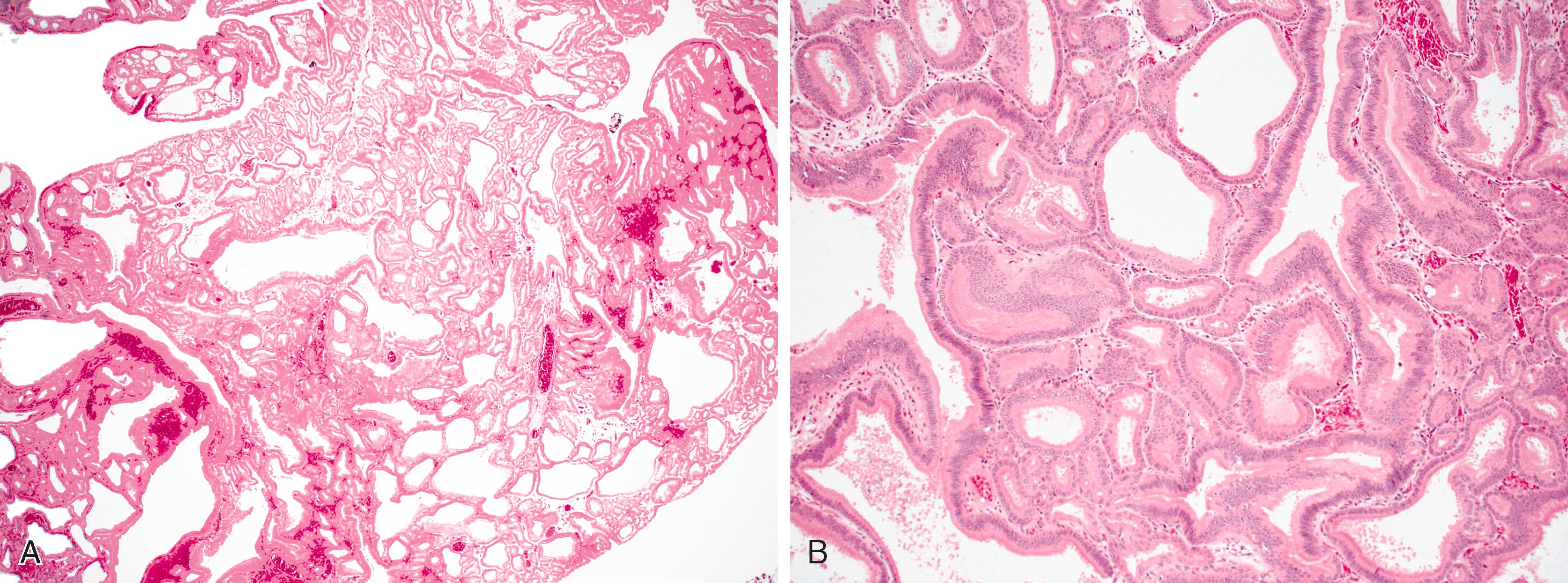 FIGURE 26.5, Pyloric gland adenoma arising in the duodenum.