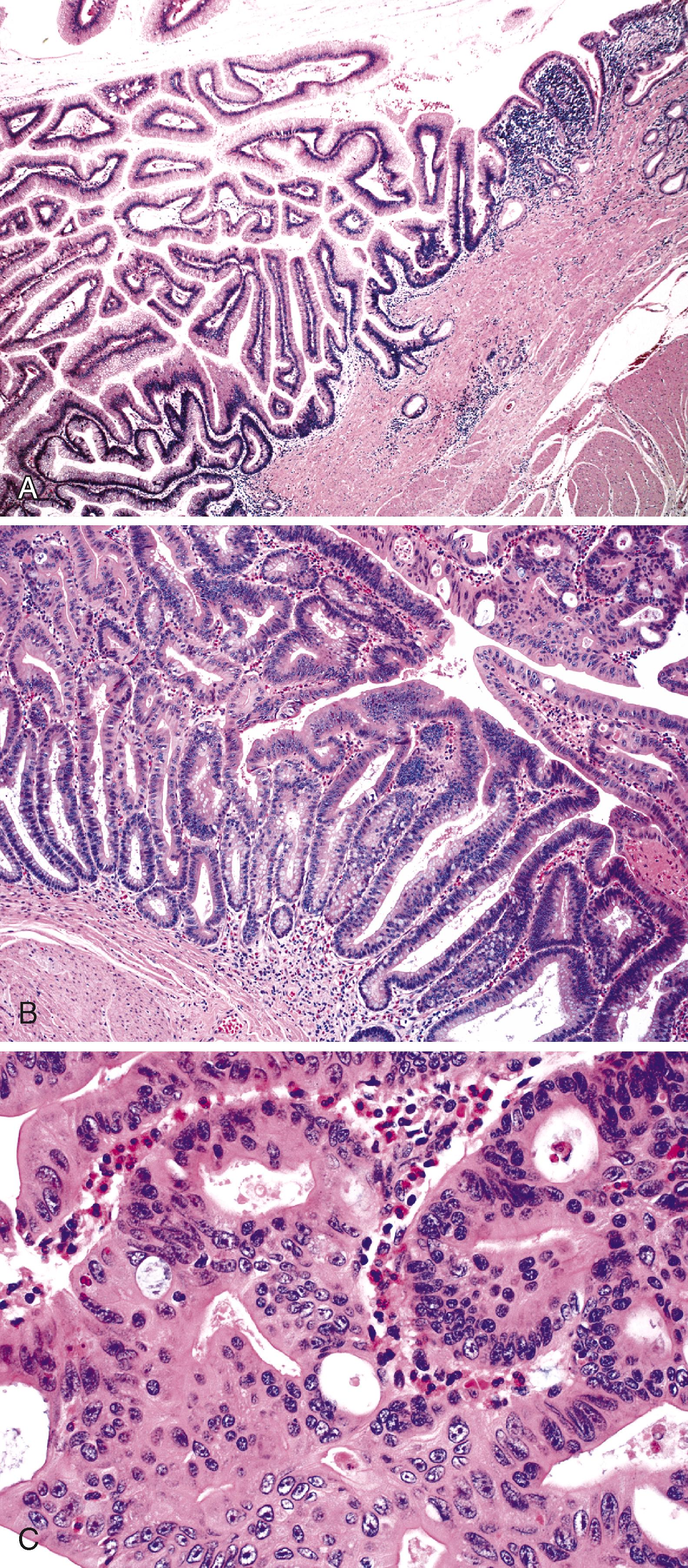 FIGURE 26.6, Intraductal papillary neoplasm involving the ampulla of Vater.