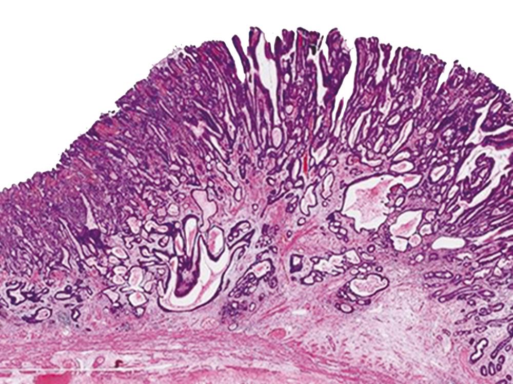 FIGURE 25.1, Early gastric cancer.