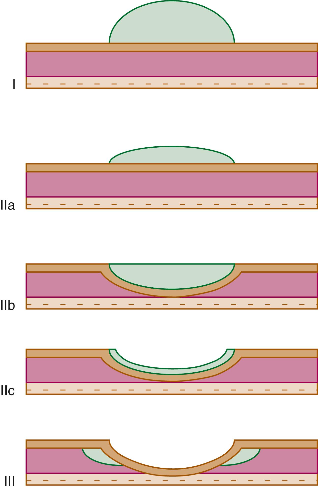 FIGURE 25.2, Endoscopic classification of early gastric cancer (Paris classification).