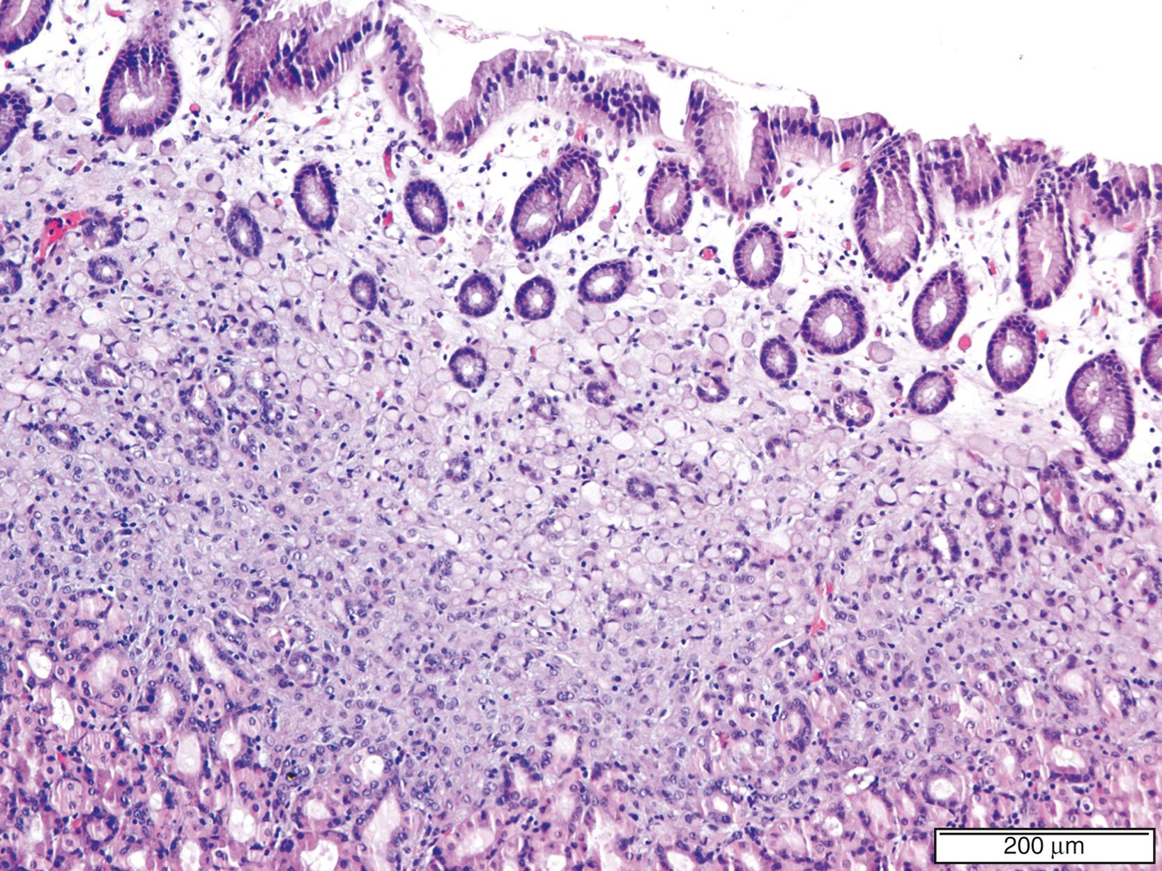 FIGURE 25.4, Early gastric cancer, signet ring cell/diffuse type.