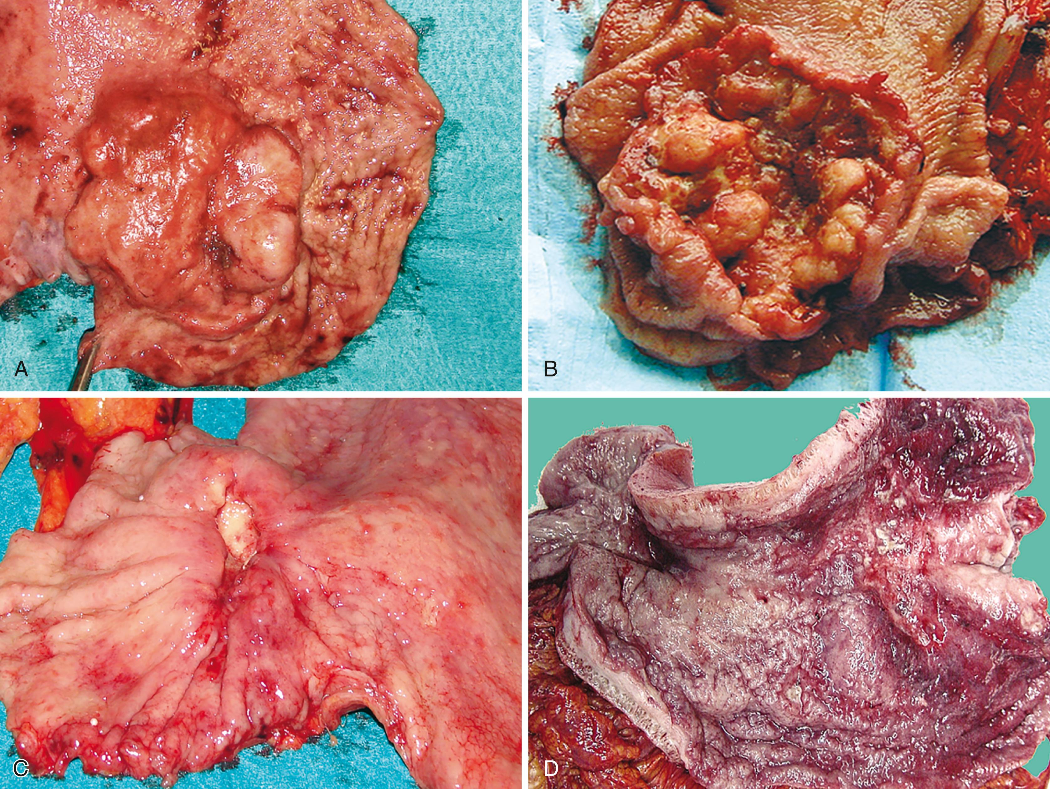 FIGURE 25.6, Growth patterns of gastric carcinoma.