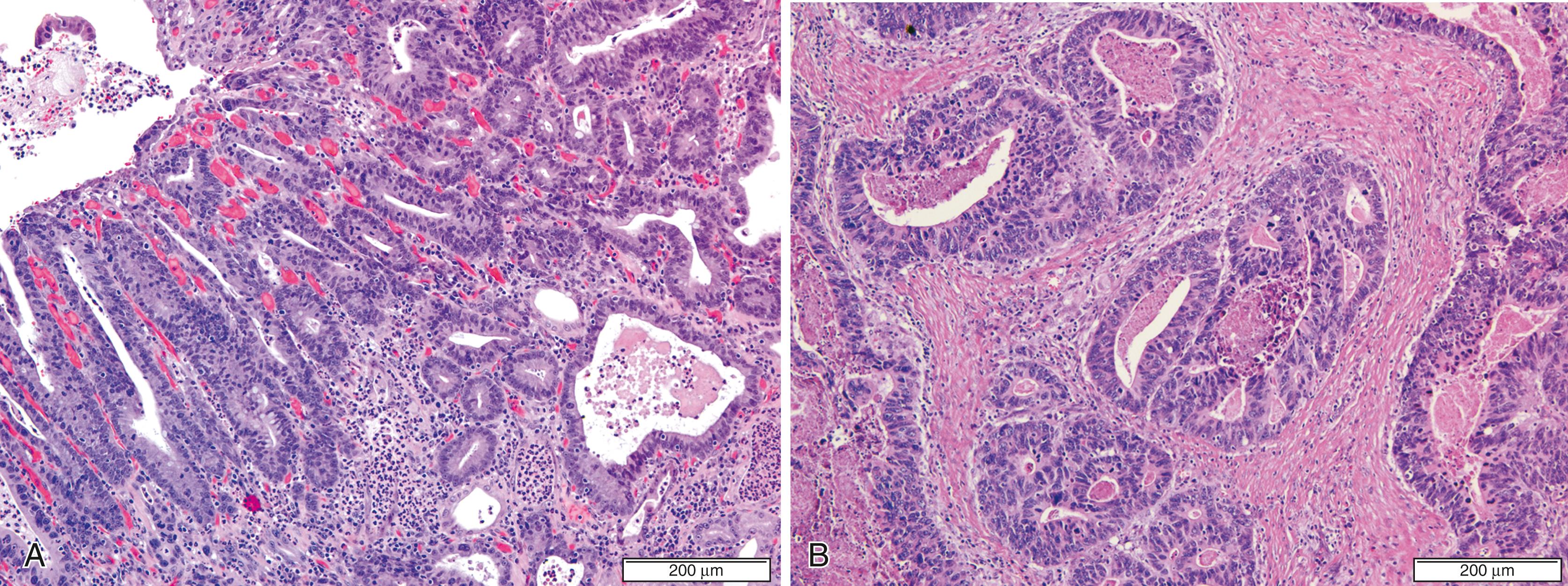 FIGURE 25.7, Tubular (WHO), intestinal (Laurén) adenocarcinoma.