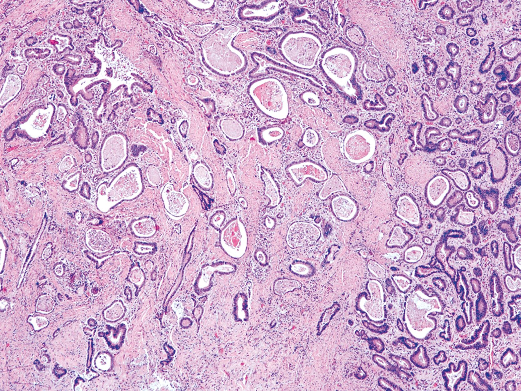 FIGURE 25.8, Tubular (WHO), intestinal (Laurén) adenocarcinoma.