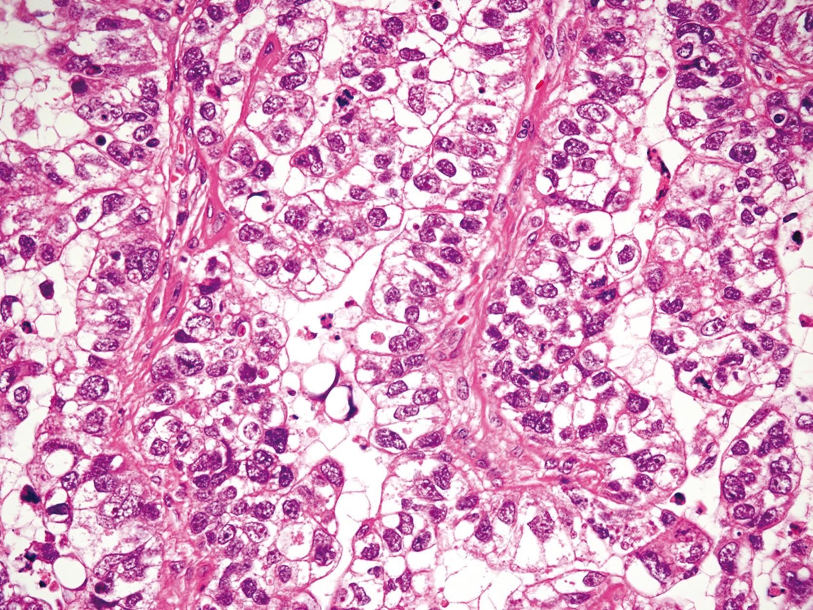 FIGURE 25.9, Tubular (WHO), intestinal (Laurén) adenocarcinoma, clear cell variant. (Courtesy Professor Ushiku, Tokyo, Japan.)