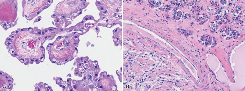 Fig. 16.1, Intracranial epithelial cells. (A) Choroid plexus contains epithelial cells and stroma with prominent blood vessels. (B) Microcystic remnants of Rathke pouch in the intermediate lobe (pars intermedia) of the pituitary gland are lined by epithelial cells (right lower image) and contain a colloid-like material. Note the neurohypophysis (left lower image) on the left side and adenohypophysis on the right side.