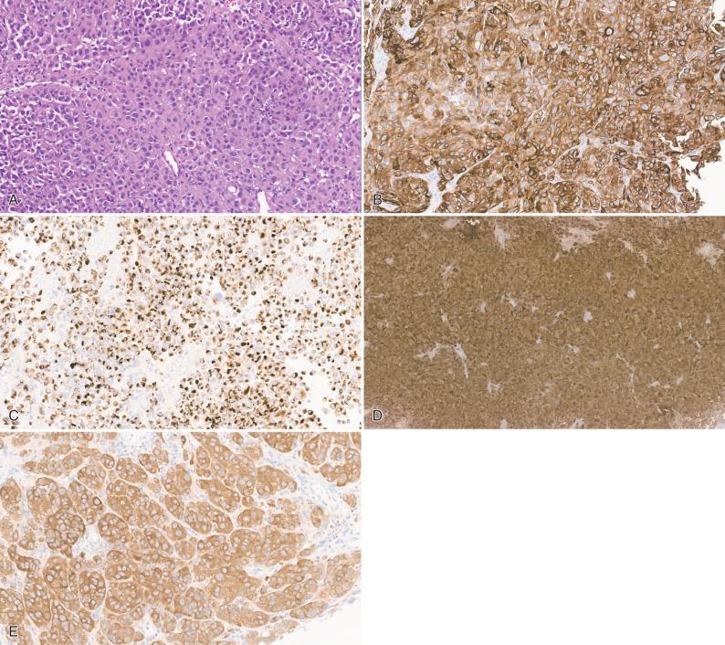 Fig. 16.12, Metastatic amelanotic melanoma. (A) Atypical epithelioid cells arranged in sheets. (B–D) Supportive immunostains include Melan-A (B), HMB-45 (C), and S-100 (D). (E) Immunohistochemical staining with a BRAF p.V600E-specific antibody confirms the presence of mutant protein and opens the possibility of BRAF targeting agents for treatment purposes.