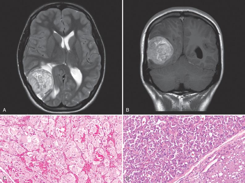 Fig. 16.13, Metastatic alveolar soft parts sarcoma (ASPS). ASPS is the most common metastatic sarcoma of unknown primary to the brain. (A) Axial MRI T2 sequence showing a T2 hyperintense, well-demarcated lesion in the right parietal lobe. (B) Coronal MRI (T1 with contrast) demonstrating the presence of contrast enhancement. Note the presence of dural tails, a feature which is typically associated with meningioma. (C) The tumor showed nests of large epithelioid cells. (D) The metastatic tumor (left) and the adjacent brain parenchyma (bottom right) are well demarcated.