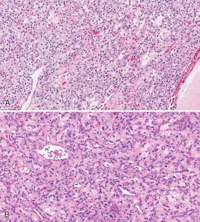 Fig. 16.14, Clear cell renal cell carcinoma (A), and hemangioblastoma (B). Note the similar clear cell cytology and high vascularity of both lesions.