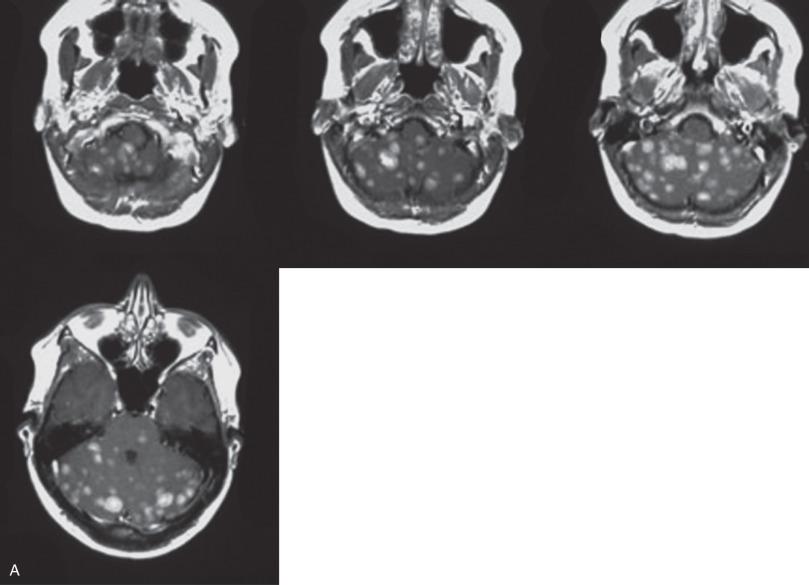 Fig. 16.2, (A) Magnetic resonance imaging (MRI) of miliary metastatic pattern. Postcontrast T1-weighted MRI from this patient reveals innumerable variably sized metastases. (B) Miliary metastatic pattern in a patient with history of lung adenocarcinoma. Tumor cells involve the subarachnoid (black arrowheads) and perivascular Virchow-Robin spaces (white arrowhead).