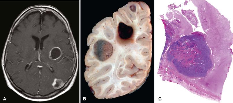 Fig. 16.3, Metastases showing sharp demarcation and typical location at the cerebral corticomedullary junction within the middle cerebral artery vascular territory. (A) Postcontrast T1-weighted MRI showing two enhancing cerebral metastases with variable degrees of necrosis (hypodensity). (B) Autopsy hemibrain from patient with metastatic lung cancer, showing three parietal lobe metastases. (C) Whole-mount section of metastatic carcinoma.