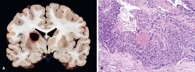 Fig. 16.4, Metastatic choriocarcinoma. (A) This markedly hemorrhagic metastasis mimicked a primary intracerebral hemorrhage in a young adult patient. (B) Histology revealed a metastatic choriocarcinoma with aggregates of mononucleated tumor cells associated with multinucleated syncytiotrophoblasts. Although rare, this is an important diagnostic consideration in young individuals, since there is a substantial response to chemotherapy.