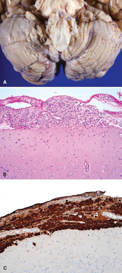 Fig. 16.5, Meningeal carcinomatosis. (A) Meningeal carcinomatosis with opacification of the leptomeninges over the right cerebellar hemisphere (compare with left). (B, C) Cortical sections reveal expansion of the subarachnoid space by carcinoma cells (B) that are immunoreactive for epithelial membrane antigen (C).