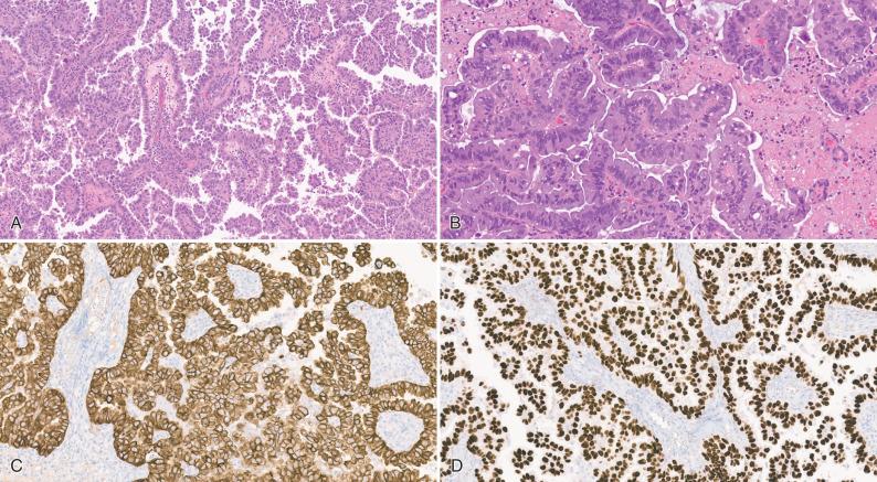 Fig. 16.7, Metastatic poorly differentiated non-small-cell lung carcinoma. (A) Histology shows a prominent papillary architecture. (B) At higher magnification, metastatic carcinoma cells surround fibrovascular cores with intervening foci of tumor necrosis. (C, D) Immunohistochemical staining for CK7 is positive in the tumor cells (C) and TTF-1 is positive in the tumor cell nuclei (D), compatible with lung as the primary site of origin.