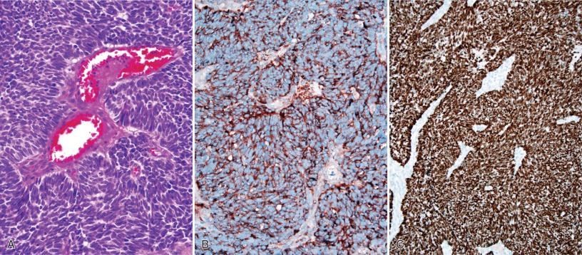 Fig. 16.8, Metastatic small-cell carcinoma of the lung. (A) This tumor shows the typical vaguely nested architecture with “small blue cells” containing oval to elongate hyperchromatic nuclei, high nuclear-to-cytoplasmic ratio, and nuclear molding. It may resemble medulloblastoma or other embryonal neoplasms, but typically occurs in older patients. (B, C) Strong expression of chromogranin A (B) and TTF-1 (C) is diagnostically useful. (D) Metastatic small-cell lung carcinoma to the cerebellum. Note the similarities between the fragment of cerebellum with reactive changes (left) and fragment of cerebellum involved by small cell carcinoma (right). (E) Higher magnification of the cerebellum showing granule cell (white asterisk) and molecular layers (black asterisk). (F) Higher magnification of the small-cell carcinoma cells with adjacent areas of necrosis.