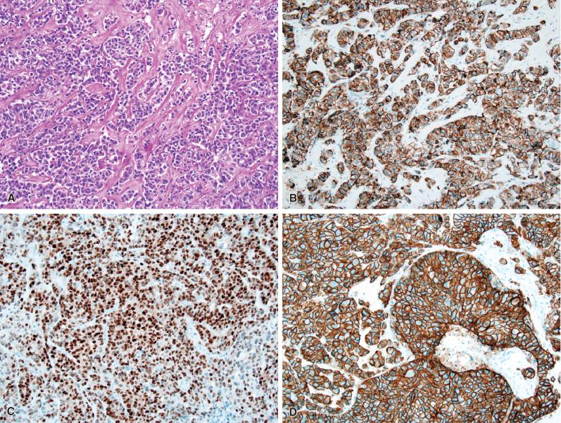 Fig. 16.9, Metastatic breast carcinoma. (A) The presence of nests and linear arrays of small to midsize epithelioid cells in a densely sclerotic stroma is suggestive, though not diagnostic, of breast carcinoma. (B–F) Variably helpful ancillary features include immunoreactivities for CK7 (B), estrogen receptor (C), HER2 (D),GCDFP-15 (E), and mammaglobin (F).