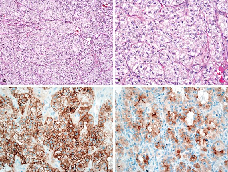 Fig. 16.10, Metastatic renal cell carcinoma (RCC). (A, B) Hypervascularity, large cells with clear cytoplasm, and prominent nucleoli are typical features of RCC. (C, D) In addition to cytokeratin and epithelial membrane antigen positivity (not shown), CD10 (C) and RCC (D) expression is common.