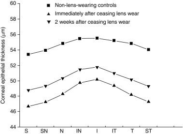 Fig. 20.1, Corneal epithelial thickness distribution in regions with a radius of 1.0 to 2.5 mm from the corneal centre. T, temporal; N, nasal; S, superior; I, inferior.