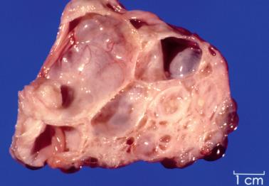 Fig. 13.1, Serous cystadenofibroma, sectioned surface.